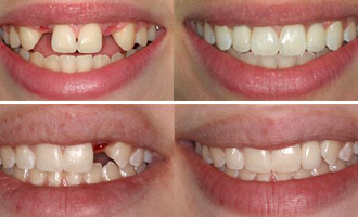 dental-implant-before-after